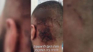 اصابات تلقاها احد ثلاثة ضحايا هجوم مفترض من قبل مجموعة يهود ضد ثلاثة رجال عرب من سكان شفاعمرو، بالقرب من شاطئ في حيفا في 23 اغسطس 2018 (Screenshot/Mako)