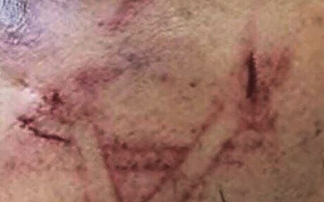 The marks on a detainee's face. Photo: Israel Police The marks on a detainee's face. Photo: Israel Police