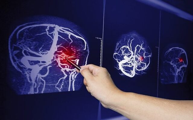 A doctor points to a brian scan image of a recent traumatic brain injury.
Photo: Rattanachot2525/Dreamstime.com A doctor points to a brian scan image of a recent traumatic brain injury.
Photo: Rattanachot2525/Dreamstime.com
