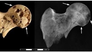 صورة لعلامات على عظام رجل دفن عام 1200 قبل الميلاد يعتقد الباحثون ان سببها مرض السرطان (photo credit: CC BY Binder et al/PLOS One)
