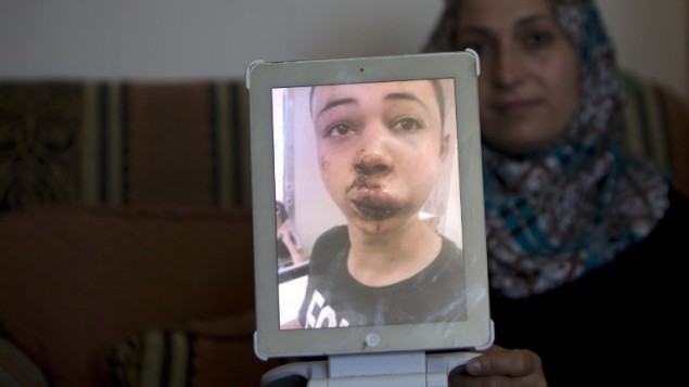 والدة طارق أبو خضير(15 عاما)، إبن عم الفتى الفلسطيني المقتول محمد، تعرض الصورة التي التقطتها لإبنها في المستشفى بعد أن تعرض للضرب على يد شرطي إسرائيلي من عناصر حرس الحدود في القدس الشرقية، 5 يوليو، 2014. (photo credit: AFP/Ahmad Gharabli) والدة طارق أبو خضير(15 عاما)، إبن عم الفتى الفلسطيني المقتول محمد، تعرض الصورة التي التقطتها لإبنها في المستشفى بعد أن تعرض للضرب على يد شرطي إسرائيلي من عناصر حرس الحدود في القدس الشرقية، 5 يوليو، 2014. (photo credit: AFP/Ahmad Gharabli)
