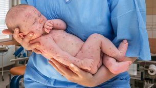 توضيحية: طفل حديث الولادة يعاني من الحصبة. (iStock by Getty Images/andriano_cz)