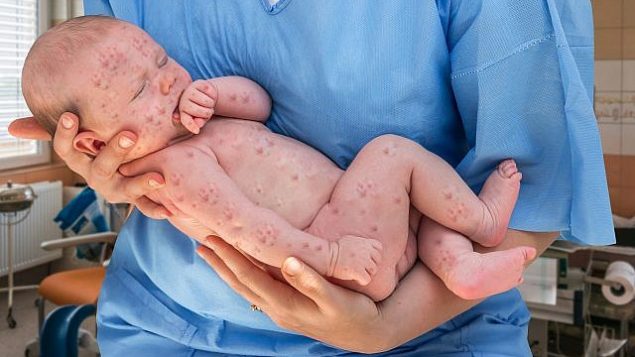 توضيحية: طفل حديث الولادة يعاني من الحصبة. (iStock by Getty Images/andriano_cz)