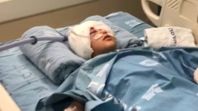 طفل (9 سنوات) أصيب في رأسه برصاصة إسفنجية خلال مداهمة للشرطة في حي العيساوية بالقدس الشرقية، في مستشفى بالقدس، 26 فبراير، 2020. (Screencapture/Channel 13)