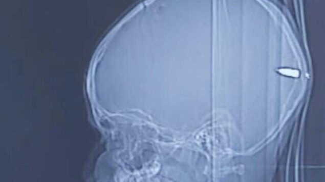 صورة بالأشعة السينية لرصاصة في دماغ طفل يبلغ من العمر 9 سنوات في مستشفى هداسا الجامعي في القدس في 31 يوليو 2020. (courtesy of Hadassah University Hospital)