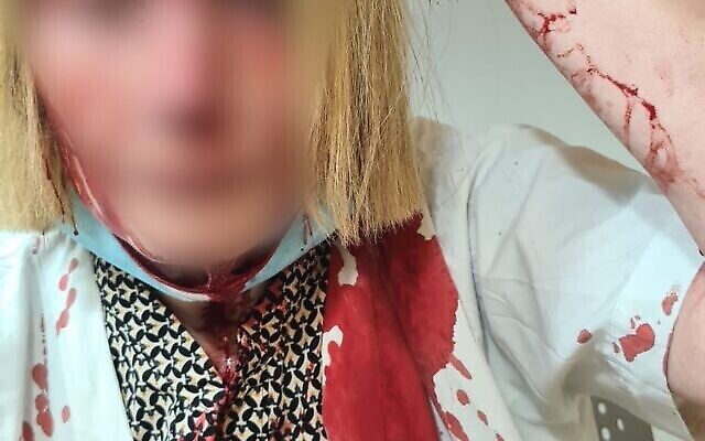 صورة نشرتها وزارة الصحة تظهر طبيبة هوجمت من قبل مريض في عيادة في بئر يعقوب في 14 حزيران 2022 (وزارة الصحة)