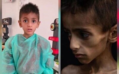 يظهر أسامة الركاب، البالغ من العمر خمس سنوات، وهو يتلقى العلاج الطبي (يسار الصورة). صرّح مكتب تنسيق أعمال الحكومة في المناطق بأن صورةً انتشرت له (يمين الصورة) استُخدمت زورًا لاتهام إسرائيل بتجويع الأطفال في غزة. (لقطة شاشة: مكتب تنسيق أعمال الحكومة في المناطق عبر X)
