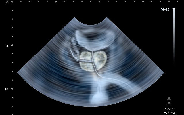 Illustrative: Ultrasound scan of human Prostate. (iStock)