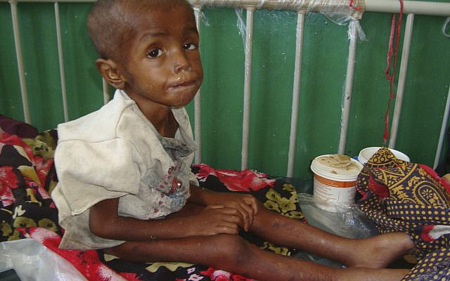Abdirisak Mohamed, 4, from southern Somalia, suffering malnourishment, at Banadir hospital, Mogadishu Somalia, July, 31, 2011. (AP Photo/Farah Abdi Warsameh)