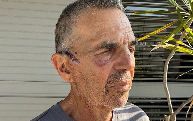 Israeli artist Oded Yedaya, injured by settlers in the West Bank, November 8, 2025. (Social media: used in accordance with Clause 27a of the Copyright Law)