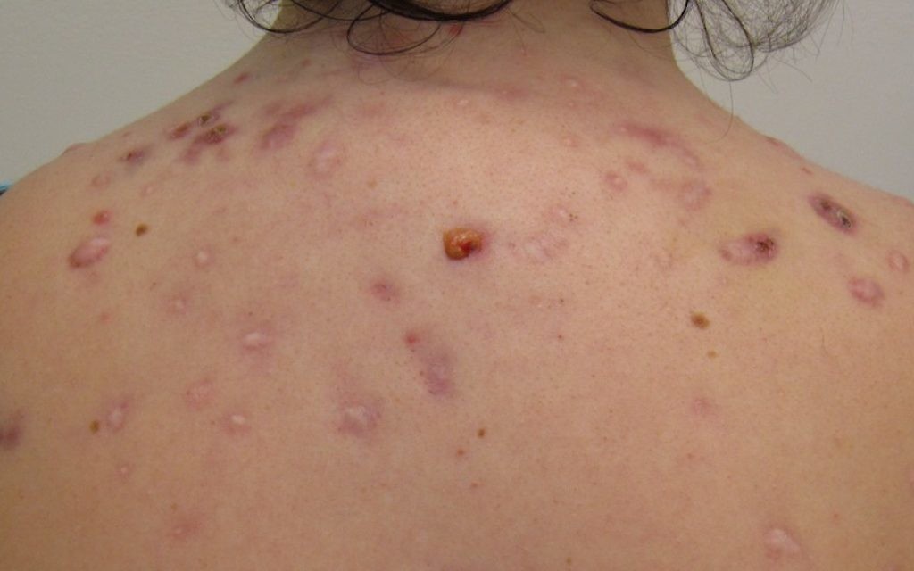 Individuel avec un cas d'acné de dos (Crédit : autorisation James Heilman, MD) Individuel avec un cas d'acné de dos (Crédit : autorisation James Heilman, MD)