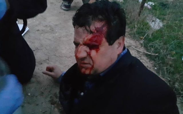 Le député arabe Ayman Odeh blessé par une balle en caoutchouc pendant des affrontements dans le village bédouin non reconnu d'Umm al-Hiran, le 18 janvier 2017. (Crédit : porte-parole de la Liste arabe unie) Le député arabe Ayman Odeh blessé par une balle en caoutchouc pendant des affrontements dans le village bédouin non reconnu d'Umm al-Hiran, le 18 janvier 2017. (Crédit : porte-parole de la Liste arabe unie)