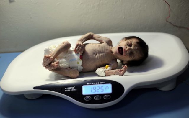 Un nourrisson syrien souffrant de malnutrition sévère est pesée dans une clinique d'Hamouria, ville contrôlée par les rebelles, dans la région orientale de la Ghouta, en périphérie de Damas, le 21 octobre 2017. (Crédit : AFP / Amer ALMOHIBANY)