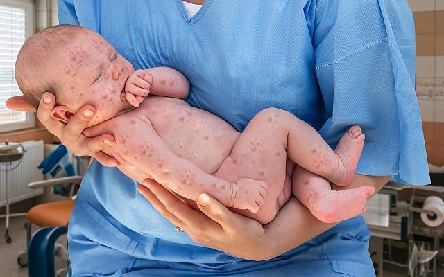 Un nouveau-né probablement atteint de rougeole (Crédit : iStock by Getty Images/ andriano_cz) Un nouveau-né probablement atteint de rougeole (Crédit : iStock by Getty Images/ andriano_cz)