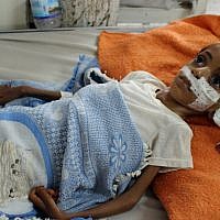 Un enfant yéménite souffrant de malnutrition est soigné dans un hôpital de la province du nord Hajjah, dans le quartier d'Abs, le 19 septembre 2018 (Crédit : . / AFP PHOTO) Un enfant yéménite souffrant de malnutrition est soigné dans un hôpital de la province du nord Hajjah, dans le quartier d'Abs, le 19 septembre 2018 (Crédit : . / AFP PHOTO)