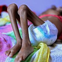 Un enfant yéménite souffrant de malnutrition à l'hôpital de Sanaa, le 6 octobre 2018. (Crédit ! MOHAMMED HUWAIS / AFP) Un enfant yéménite souffrant de malnutrition à l'hôpital de Sanaa, le 6 octobre 2018. (Crédit ! MOHAMMED HUWAIS / AFP)