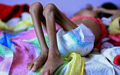 Un enfant yéménite souffrant de malnutrition à l'hôpital de Sanaa, le 6 octobre  2018. (Crédit ! MOHAMMED HUWAIS / AFP)