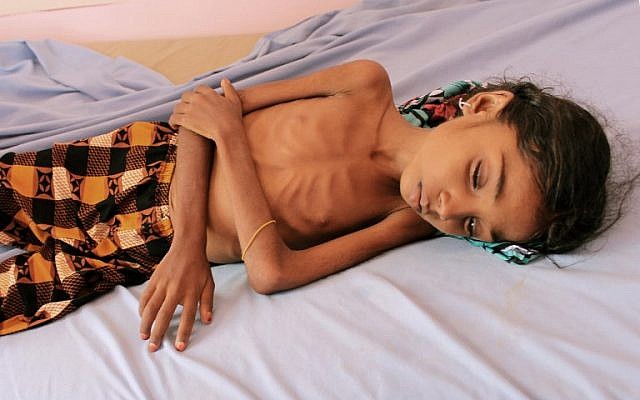 Un enfant yéménite souffrant de malnutrition dans un hôpital de Hajjah, le 25 octobre 2018. (Crédit : ESSA AHMED / AFP) Un enfant yéménite souffrant de malnutrition dans un hôpital de Hajjah, le 25 octobre 2018. (Crédit : ESSA AHMED / AFP)