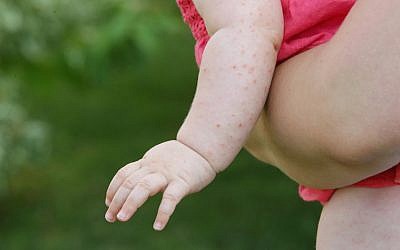 Image illustrative d'un bébé atteint d'une maladie de la peau. (Triocean/iStock Images/Getty)