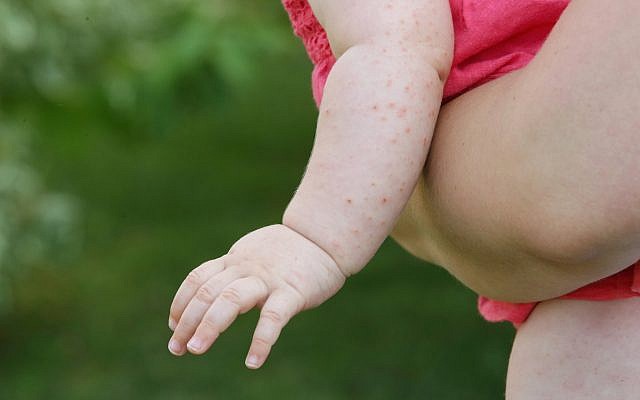 Image illustrative d'un bébé atteint d'une maladie de la peau. (Triocean/iStock Images/Getty) Image illustrative d'un bébé atteint d'une maladie de la peau. (Triocean/iStock Images/Getty)