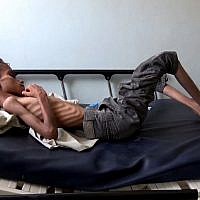 Ghazi Saleh, 8 kilos pour 10 ans, dans un lit d'hôpital de Taez au Yémén, le 19 novembre 2018. (Crédit : Marzooq AL-JABIRY / AFP) Ghazi Saleh, 8 kilos pour 10 ans, dans un lit d'hôpital de Taez au Yémén, le 19 novembre 2018. (Crédit : Marzooq AL-JABIRY / AFP)