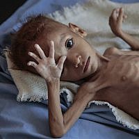 Un enfant souffrant de malnutrition pris en charge à l’hôpital Aslam Health Center, à Hajjah, au Yemen, le 1 octobre 2018. (Crédit : AP/Hani Mohammed) Un enfant souffrant de malnutrition pris en charge à l’hôpital Aslam Health Center, à Hajjah, au Yemen, le 1 octobre 2018. (Crédit : AP/Hani Mohammed)
