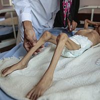 Un enfant souffrant de malnutrition pris en charge à l’hôpital Aslam Health Center, à Hajjah, au Yemen, le 1 octobre 2018. (Crédit : AP/Hani Mohammed) Un enfant souffrant de malnutrition pris en charge à l’hôpital Aslam Health Center, à Hajjah, au Yemen, le 1 octobre 2018. (Crédit : AP/Hani Mohammed)