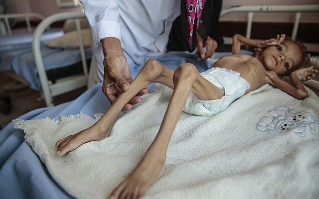 Un enfant souffrant de malnutrition pris en charge à l’hôpital Aslam Health Center, à Hajjah, au Yemen, le 1 octobre 2018. (Crédit : AP/Hani Mohammed) Un enfant souffrant de malnutrition pris en charge à l’hôpital Aslam Health Center, à Hajjah, au Yemen, le 1 octobre 2018. (Crédit : AP/Hani Mohammed)