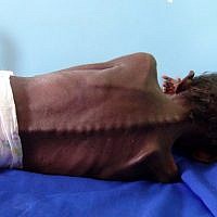 Abdelrahman Manhash, 5 ans, souffrant de malnutrition sévère, à l'hoital de Khokha au Yemen., (Crédit : AFP) Abdelrahman Manhash, 5 ans, souffrant de malnutrition sévère, à l'hoital de Khokha au Yemen., (Crédit : AFP)