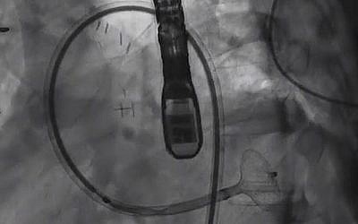 Professeur Victor Guetta, directeur de l'unité de cardiologie invasive et interventionnelle, et son équipe, au centre médical Sheba de Ramat Gan, a rebouché l'artère d'un patient de 29 ans avec un dispositif utilisé pour déboucher des artères. (Crédit : capture d'écran YouTube)