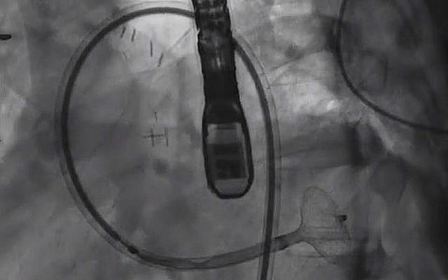 Professeur Victor Guetta, directeur de l'unité de cardiologie invasive et interventionnelle, et son équipe, au centre médical Sheba de Ramat Gan, a rebouché l'artère d'un patient de 29 ans avec un dispositif utilisé pour déboucher des artères. (Crédit : capture d'écran YouTube) Professeur Victor Guetta, directeur de l'unité de cardiologie invasive et interventionnelle, et son équipe, au centre médical Sheba de Ramat Gan, a rebouché l'artère d'un patient de 29 ans avec un dispositif utilisé pour déboucher des artères. (Crédit : capture d'écran YouTube)