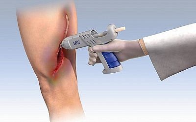 Des chercheurs du Technion ont développé un pistolet de glue médicale pour aider à soigner les tissus humains qui ont été gravement blessés. (Crédit)