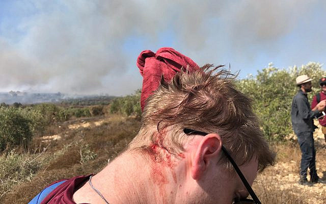 Un volontaire de Yesh Din avec les blessures subies lors d'une altercation avec les habitants d'implantations en Cisjordanie le 16 octobre 2019. (Crédit : Yesh Din / Lexie Botzum)