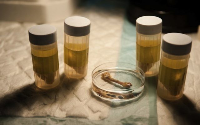 Fioles de matière adipeuse utilisée par Bonus BioGroup pour les procédures de régénération osseuse. (Crédit : autorisation) Fioles de matière adipeuse utilisée par Bonus BioGroup pour les procédures de régénération osseuse. (Crédit : autorisation)