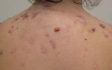 Individuel avec un cas d'acné de dos (Crédit : autorisation James Heilman, MD)