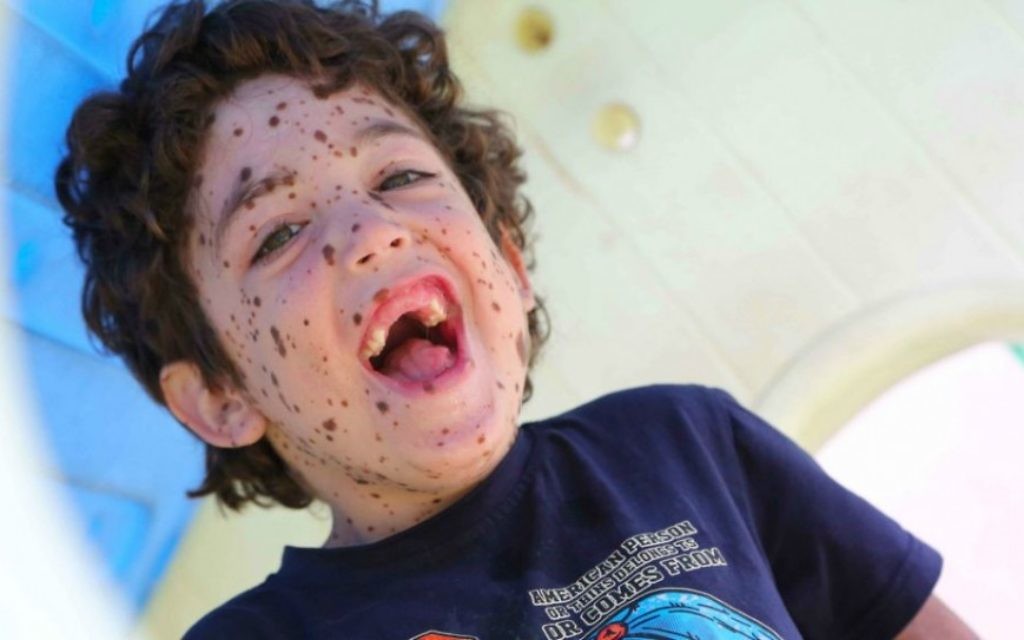 Erez est âgé de 6 ans et a une maladie rare de la peau (Crédit : Rick Guidotti)