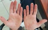 Les mains d'un homme qui a essayé d'effacer ses empreintes digitales après avoir été arrêté par la police en août 2016. (Crédit : police israélienne)