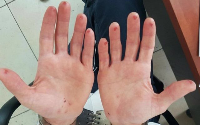 Les mains d'un homme qui a essayé d'effacer ses empreintes digitales après avoir été arrêté par la police en août 2016. (Crédit : police israélienne)