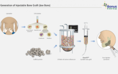 La société israélienne BonusBioGroup a mis au point un greffon liquide,  Bonofill, aux capacités d'adaptation renforcées. (Crédit: BonusBioGroup)