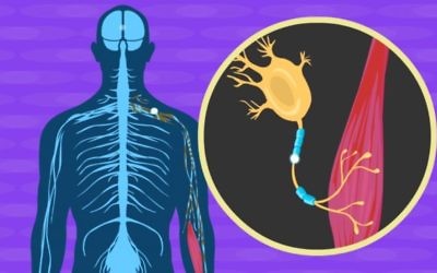 Illustration du processus neurologique à l’œuvre dans la sclérose latérale amyotrophie, dite maladie de Charcot. (Crédit : capture d'écran Moovly/YouTube)
