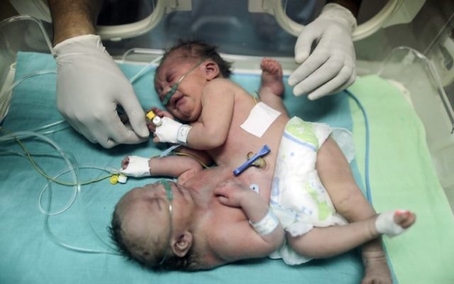 Des jumelles siamoises palestiniennes dans une couveuse le 22 octobre 2017 à l'hôpital al-Shifa de la ville de Gaza (Crédit : MAHMUD HAMS / AFP) Des jumelles siamoises palestiniennes dans une couveuse le 22 octobre 2017 à l'hôpital al-Shifa de la ville de Gaza (Crédit : MAHMUD HAMS / AFP)