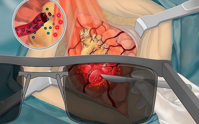 Illustration de la chirurgie guidée par l'image à l'aide de sondes qui s'allument en présence de cellules cancéreuses, technologie développée par des chercheurs de l'Université de Tel Aviv. (Illustration de Maayan Harel) Illustration de la chirurgie guidée par l'image à l'aide de sondes qui s'allument en présence de cellules cancéreuses, technologie développée par des chercheurs de l'Université de Tel Aviv. (Illustration de Maayan Harel)