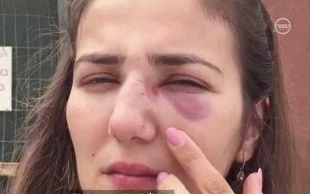 Tova Orlero montre les blessures résultant d'une agression entraînée par un coup de klaxon dans la ville d'Afula, dans le nord du pays, le 29 juin 2018 (Capture d'écran : Dixième chaîne)