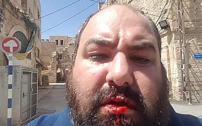 Yehuda Shaul, co-fondateur de Breaking the Silence, après avoir été frappé au visage par un militant de droite à Hébron le 27 juillet 2018. (Breaking the Silence)