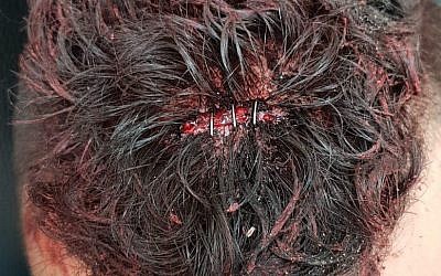 Le blessure de l'une des trois victimes arabes agressées sur une plage de Haïfa par un groupe de Juifs (Crédit : Facebook)
