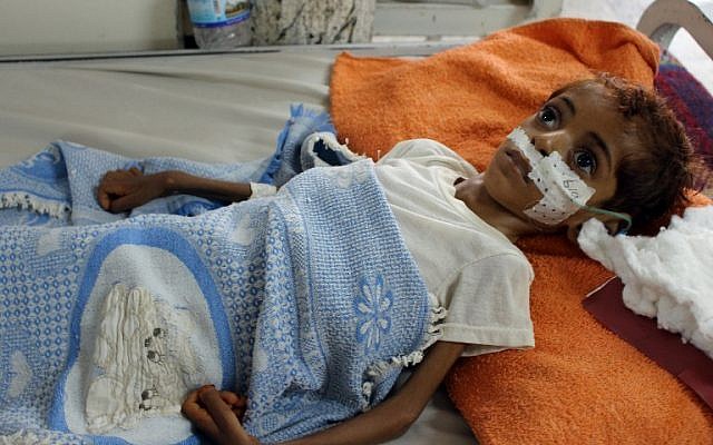 Un enfant yéménite souffrant de malnutrition est soigné dans un hôpital de la province du nord Hajjah, dans le quartier d'Abs, le 19 septembre 2018 (Crédit : . / AFP PHOTO) Un enfant yéménite souffrant de malnutrition est soigné dans un hôpital de la province du nord Hajjah, dans le quartier d'Abs, le 19 septembre 2018 (Crédit : . / AFP PHOTO)