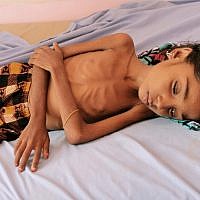 Un enfant yéménite souffrant de malnutrition dans un hôpital de Hajjah,  le 25 octobre 2018. (Crédit : ESSA AHMED / AFP)