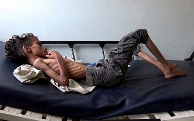 Ghazi Saleh, 8 kilos pour 10 ans, dans un lit d'hôpital de Taez au Yémén, le 19 novembre 2018. (Crédit : Marzooq AL-JABIRY / AFP)