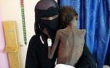 Une femme yéménite Nadia Nahari porte son fils de 5 ans Abdelrahman Manhash, souffrant de malnutrition sévère, à l'hoital de Khokha au Yemen. (Crédit : AFP)