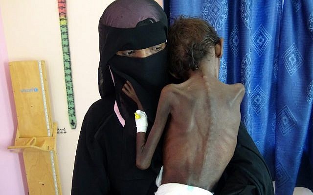 Une femme yéménite Nadia Nahari porte son fils de 5 ans Abdelrahman Manhash, souffrant de malnutrition sévère, à l'hoital de Khokha au Yemen. (Crédit : AFP) Une femme yéménite Nadia Nahari porte son fils de 5 ans Abdelrahman Manhash, souffrant de malnutrition sévère, à l'hoital de Khokha au Yemen. (Crédit : AFP)